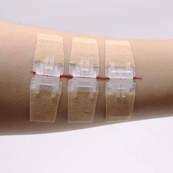 Butterfly Kit Supplier - Zip Stitch Wound Closure