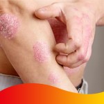 Antifungal Ointment Manufacturer - Sulfur Mite Cream