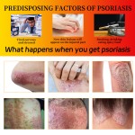 Eczema Cream Supplier - Herbal Customization