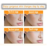 Freckle Cream Supplier - Face Acne Melasma Removal