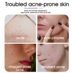 Acne Patch Factory - Hydrocolloid Pimple Treatment