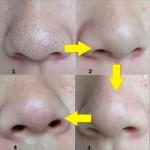 Blackhead Remove Mask Supplier - Peel Nasal Strips Deep