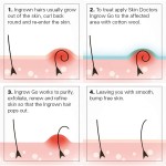 Ingrown Hair Serum Manufacturer - Dark Spot Corrector