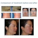 EMRF Facial Device Factory - 6 Pads Double Chin Removal