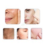 Professional Microneedle Manufacturer - RF Skin Tightening