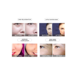 Portable Mesotherapy Factory - No Needle RF Skin Machine