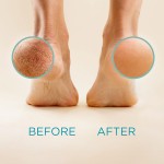 Private Label Exfoliate Pedicure Results Foot  Heel  Callus Remover Extra Strength Gel for Feet