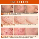 Acne Skin Care Manufacturer - Anti Bacterial