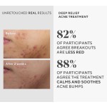 Acne Care Kit Supplier - Oily Skin Sebum