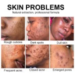 Acne Solutions Factory - Sensitive Skin Gentle
