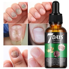 Nail Serum Manufacturer - OEM 7 Days Fungus Treatment Herbal Oil