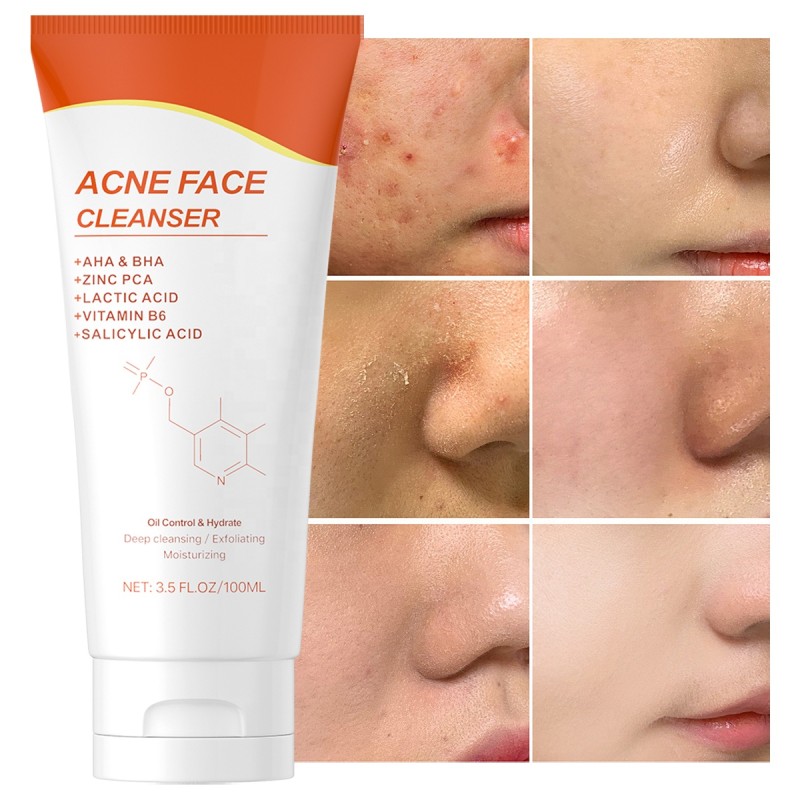 Acne Face Wash Factory - OEM Natural Tea Tree Salicylic Acid Cleanser