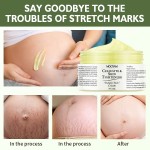 Stretch Mark Cream Factory - OEM Anti Wrinkle Pregnancy Scars Repair