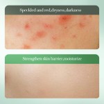 Salicylic Acid Lotion Supplier - OEM Dark Spot Repair Acne Gel Moisturizing