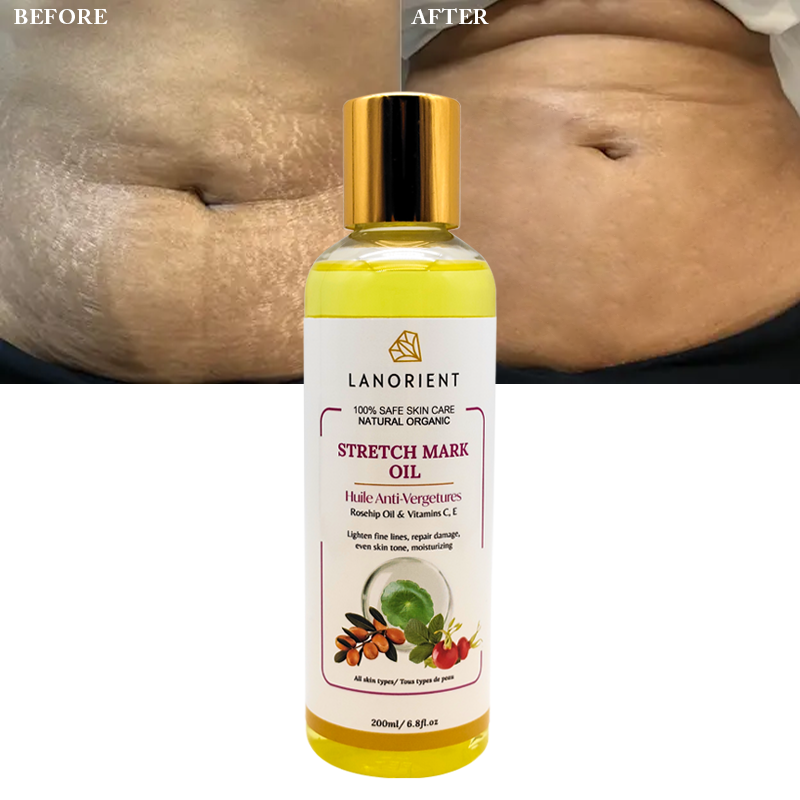 Private Label Natural Organic Vitamin C Skin Revitalizing Stretch Mark Removal Oil Skin Moisturizing Stretch Mark Oil for Women