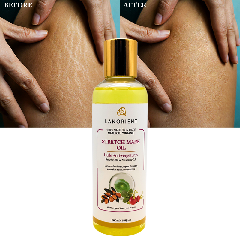 100% Natural Organic Vitamin E Skin Care to Remove Stretch Marks Skin Revitalizing Body Massage Oil for Women