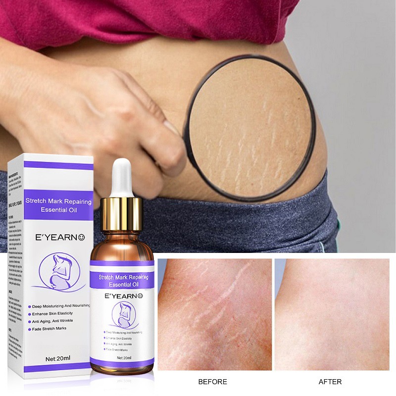 Maternity Stretch Marks Removal Oil Body Buttock Breast Mark Skin Care Effective Anti White Stretch Scar Remover Oil