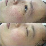最畅销的3波长二极管激光皮秒色素去除纹身去除机
