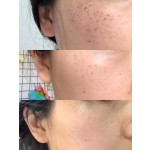 垂直色素处理皮秒1064+532+755nm激光纹身去除皮激光器