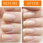 Nail Gel Manufacturer - Fungal Treatment Whitening Removal Gel