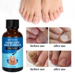 Nail Treatment Oil Manufacturer - Herbal Prevents Inflammation Oil