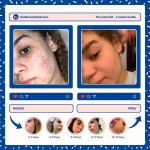 Acne Care Kit Factory - Face Cleanser Sunscreen Night Day Cream