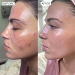 Acne Cream Supplier - Salicylic Acid Pimple Removal Pore Shrinking