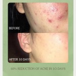 Acne Care Set Manufacturer - Cleansing Acid Toner Repairing Cream