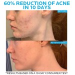 Acne Cream Supplier - Salicylic Acid Pimple Removal Pore Shrinking