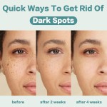 Dark Spot Remover Cream Manufacturer - OEM/ODM Natural Pimples Melasma Bleaching