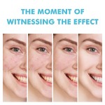 Acne Gel Supplier - Salicylic Acid Plant Essence Night Use Gel