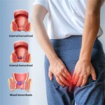 Hemorrhoids Cream Manufacturer - Private Label Anal Fissure Itching Swelling Treatment