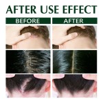 Hair Shampoo Manufacturer - OEM Private Label Anti Dandruff Seborrheic Dermatitis