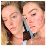 BHA Serum Manufacturer - OEM Factory Custom Anti Acne Spot Treatment Repair Shrink Pores