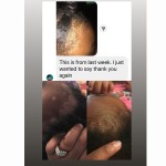 Lice Removal Shampoo Manufacturer - OEM Advanced Cleaning Relieving Itching Oil Control