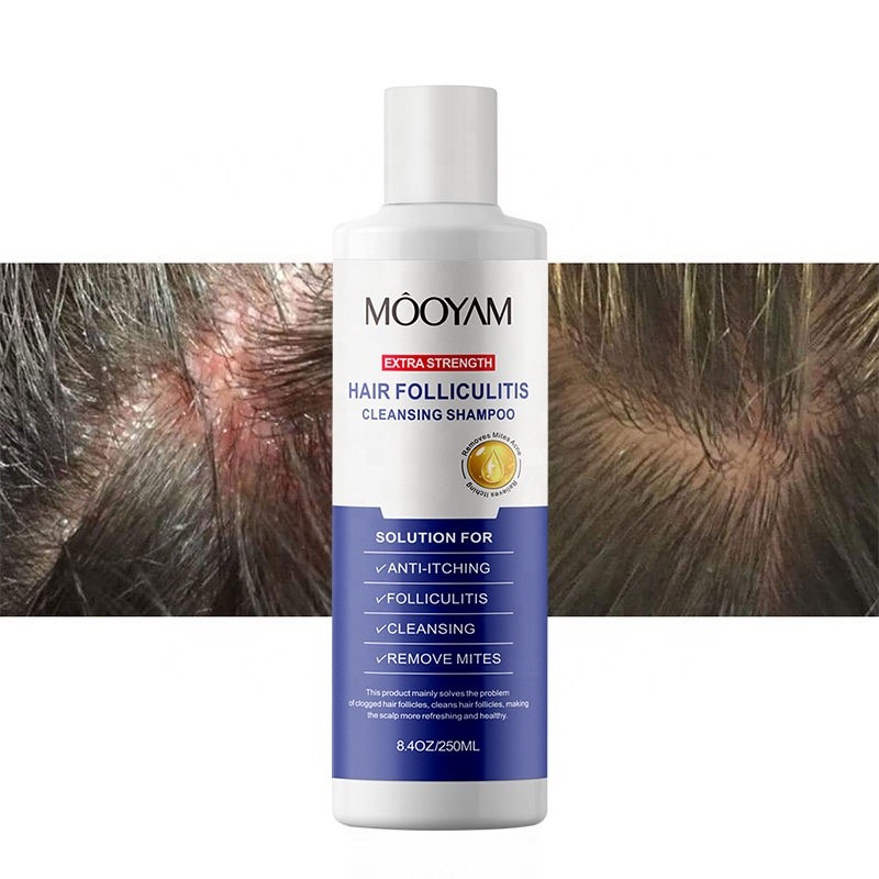 Anti Acne Extra Strength Hair Folliculitis Cleansing Shampoo Folliculitis Shampoo Seborrheic Dermatitis Shampoo