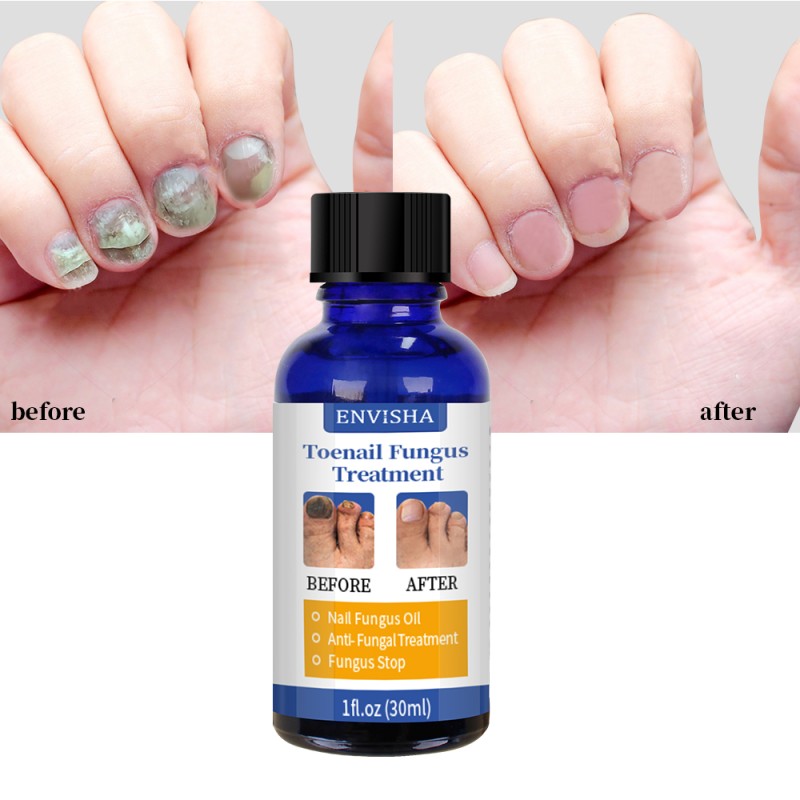 Nail Care Treatment Oil Manufacturer - Hot Sale Effectively Hand Feet Fungal Nail Repair Oil