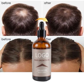 Hair Growth Oil Supplier - Organic Ginger Anti Hair Loss Treatment