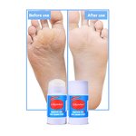Foot Balm Manufacturer - Repair Dry Cracked Skin Urea Cream Stick