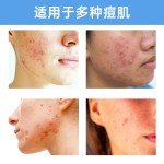 彩色痘痘贴片爱心五角星遮瑕膏痘痘贴片水胶体痘痘痘印覆盖贴片