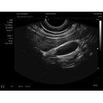 Laptop Ultrasound Scanner Factory - New B/W Device Portable with PW/ IMT