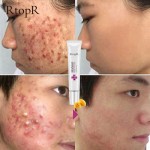 热卖最好的疤痕去除霜作为皮肤护理批发液体腮红私人标签