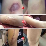 热卖皮肤护理抗疤痕旧疤痕在腿和脸