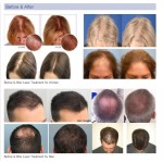 激光帽生产商-批发家用冷却提升护肤