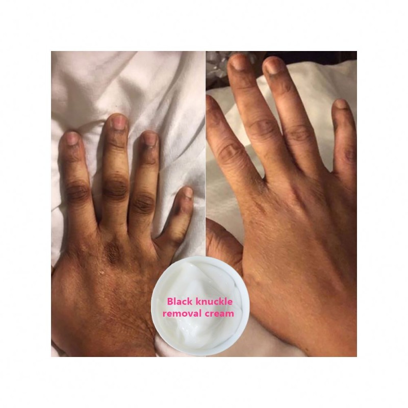 Dark Spot Corrector Manufacturer - Bulk Elbows Knuckles Pigmentation Remover