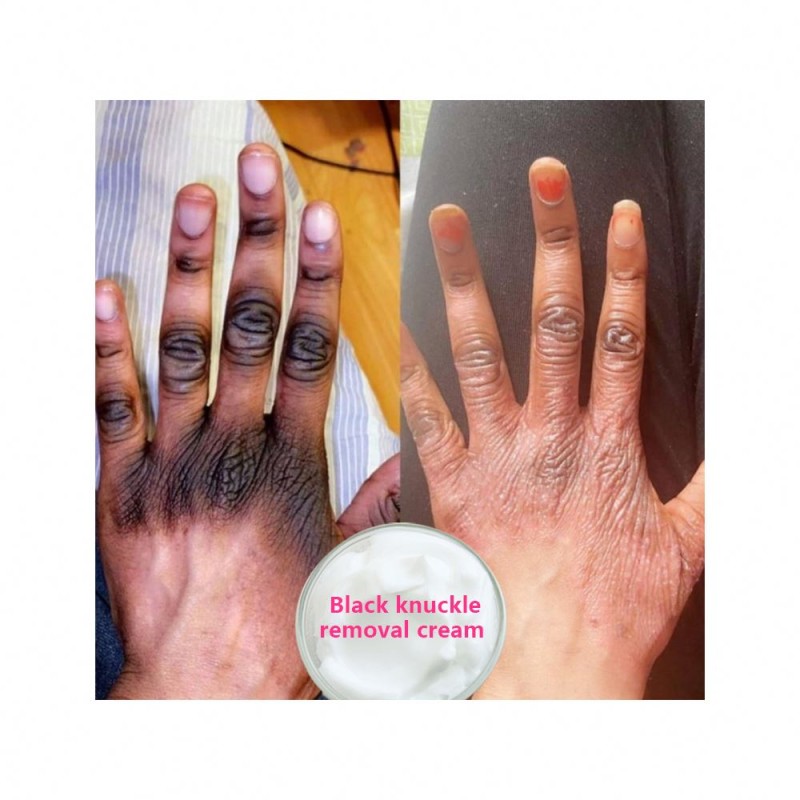 Melasma Treatment Cream Factory - Bulk Anti Melasma Face Whitening Formula