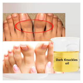 Body Bleaching Cream Supplier - OEM Dark Knuckles Spot Removal Mixed Ingredients