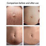 Stretch Marks Set Manufacturer - Effective Removal