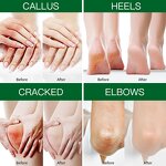 Foot Cream Manufacturer - Dead Skin Remover Urea