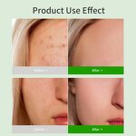 Witch Hazel Toner Factory - Soothe Repairing Acne Treatment for Mixed Skin